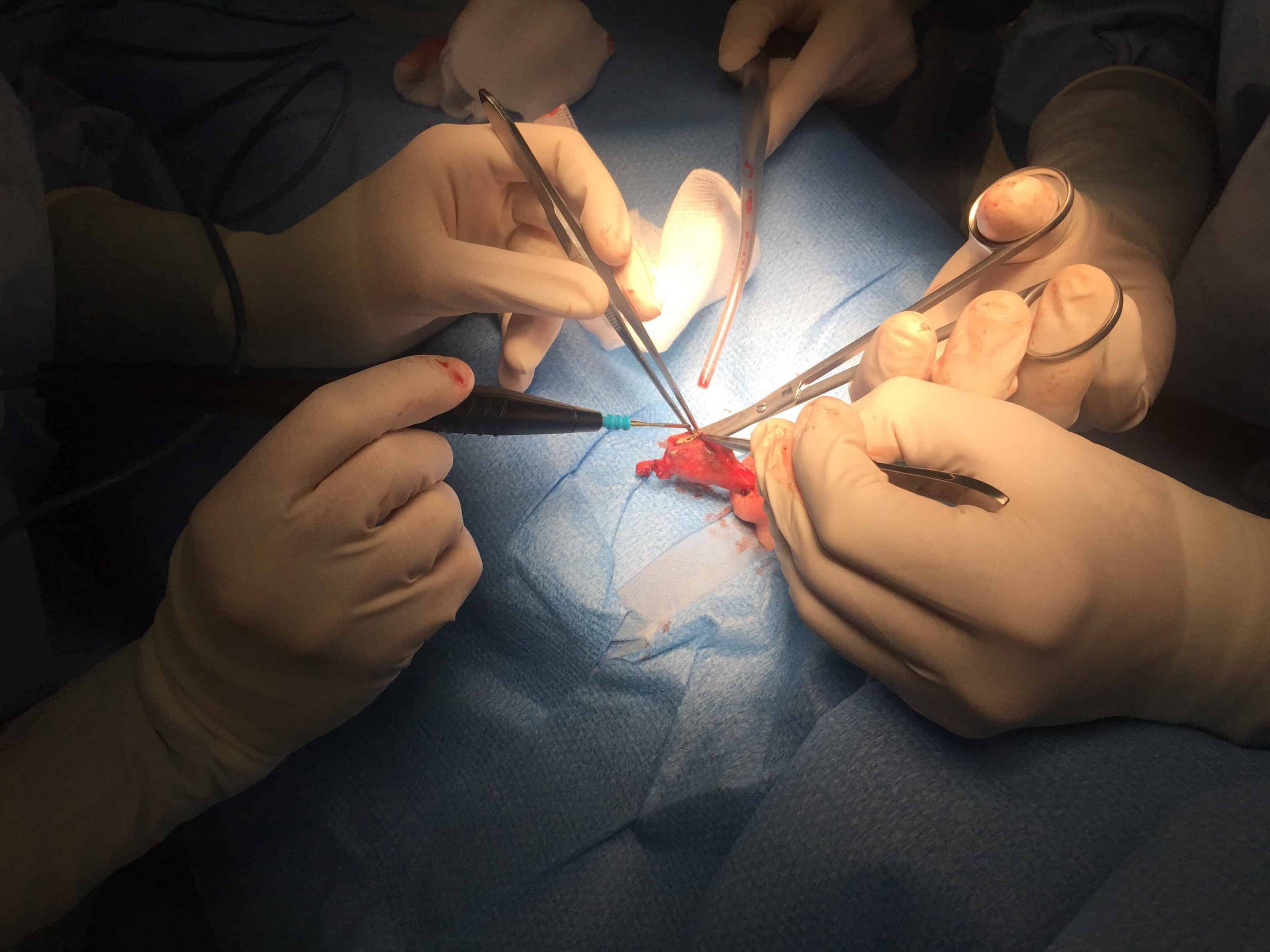 ניתוח קשירת צינורות הזרע (וזקטומיה, Vasectomy)